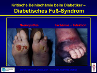 Abbildung 25: Diabetisches Fuß-Syndrom