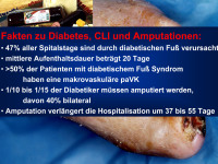 Abbildung 29: Diabetes mellitus - CLI - Amputation