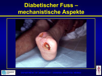 Abbildung 89: Diabetische Fuß