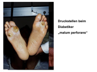 Abbildung 92: Malum perforans