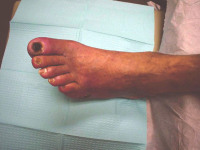 Abbildung 23: Kritische Beinischämie