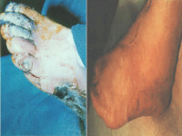 Abbildung 25: Kritische Beinischämie