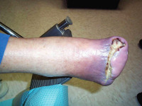 Abbildung 26: Kritische Beinischämie