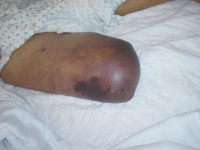 Abbildung 27: Kritische Beinischämie