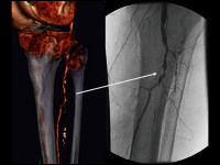 Abbildung 36: Kritische Beinischämie