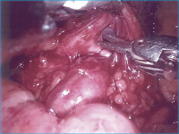 Abbildung 3: Kreuzendes Unterolgefäß