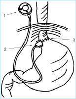 Abbildung 1: Magenbandimplantation