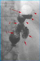 Abbildung 12: Roux-Y-Magenbypass