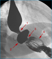 Abbildung 13: Roux-Y-Magenbypass