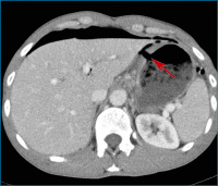 Abbildung 1: Perforierter Ulkus
