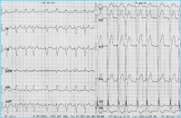 Abbildung 1: Tachykardes Vorhofflimmern