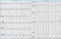 Abbildung 2: ST-Hebung - Posterolateralbereich