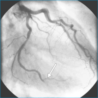 Abbildung 3: Arteria circumflexa