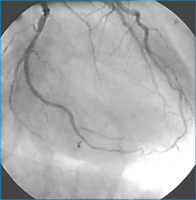 Abbildung 4: Rekanalisation - Ballondilatation