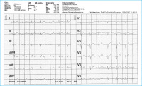 Abbildung 1: Sinusrhythmus mit peripherer Niedervoltage