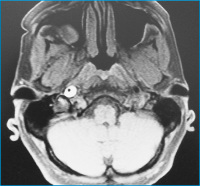 Abbildung 2: Horner-Syndrom
