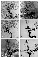 Abbildung 6a-f: Coil nach Clip