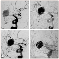 Abbildung 8a-d: Ballon-Angioplastie