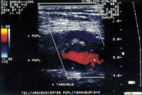 Abbildung 4: Popliteal Aneurysm