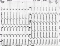 Abbildung 1: 12-Kanal-EKG