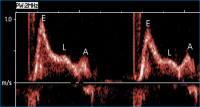 Abbildung 3: Gepulster Doppler - Mitraldoppler