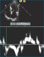 Abbildung 4: Gepulster Doppler