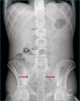 Abbildung 2: Dünndarmspiegel