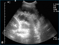 Abbildung 3a: Dünndarmschlingen