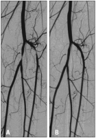 Abbildung 1: Claudicatio intermittens