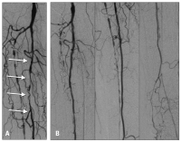 Abbildung 2a-b: Ischämie