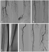 Abbildung 5: Diabetes mellitus - Ischämie