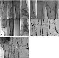 Abbildung 6a-e: Ischämie