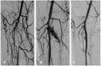 Abbildung 7: Venenverschluß