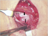 Abbildung 1: Intraoperativer Situs