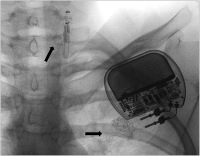 Abbildung 2: VNS-Therapie