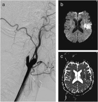 Abbildung 1: Arteria carotis - Dissektion