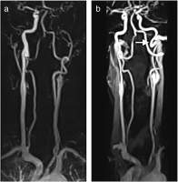 Abbildung 2: Arteria carotis - Dissektion