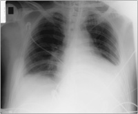Abbildung 3: Thoraxröntgen
