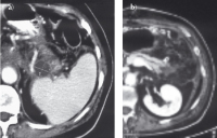 Abbildung 1: Chronische Pankreatitis