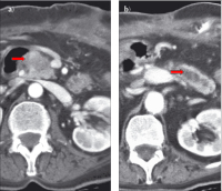 Abbildung 5: Chronische Pankreatitis