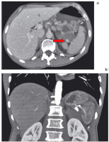 Abbildung 6: Chronische Pankreatitis