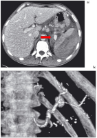 Abbildung 7: Chronische Pankreatitis