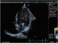 Abbildung 1: Mitralinsuffizienz