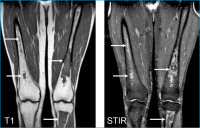 Abbildung 1: Knocheninfarkt