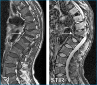 Abbildung 3: Wirbelkörperfraktur
