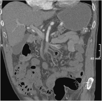 Abbildung 1: A. mesenterica superior