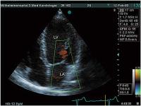 Abbildung 3: Mitralklappe