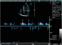 Abbildung 4: Transmitrales CW-Dopplerregistrierung